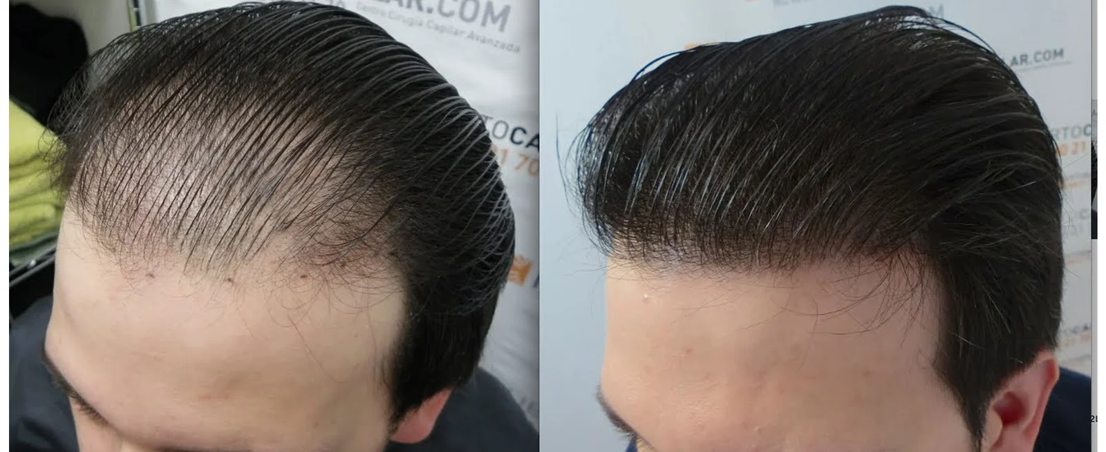 hair transplant doctor karnal