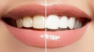 Teeth Whitening